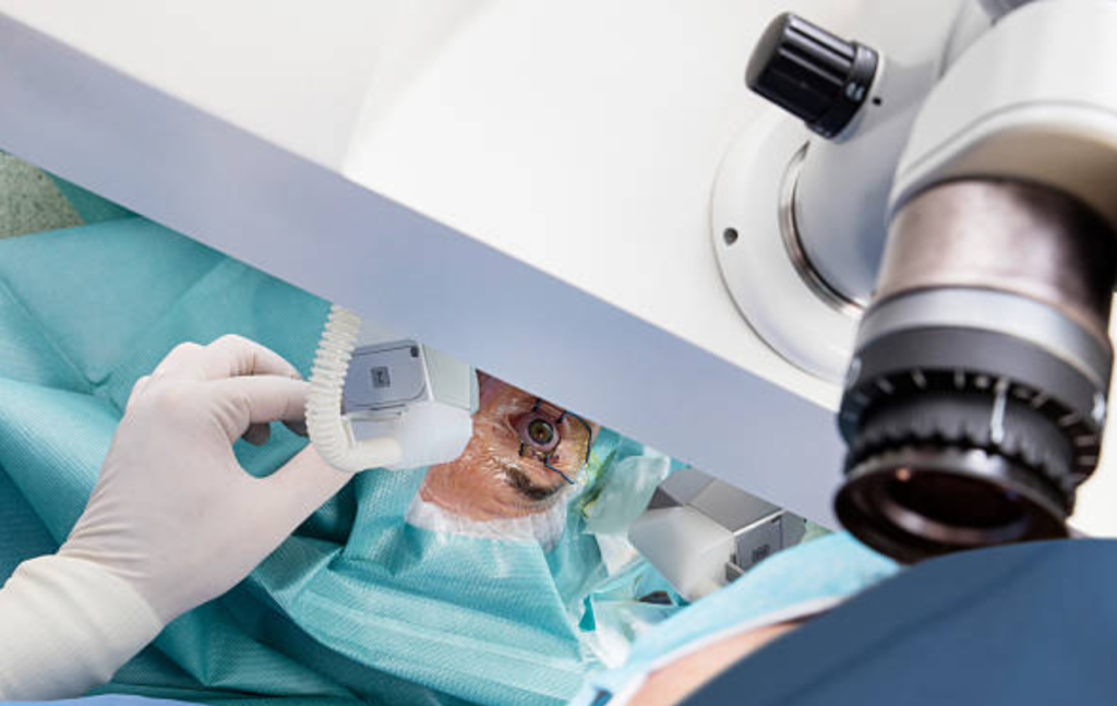 MICS Cataract Surgery in Lucknow