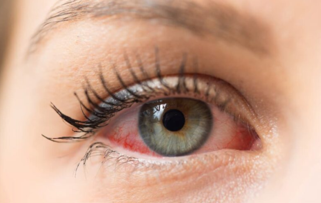 Dry Eye Disease Treatment in Lucknow