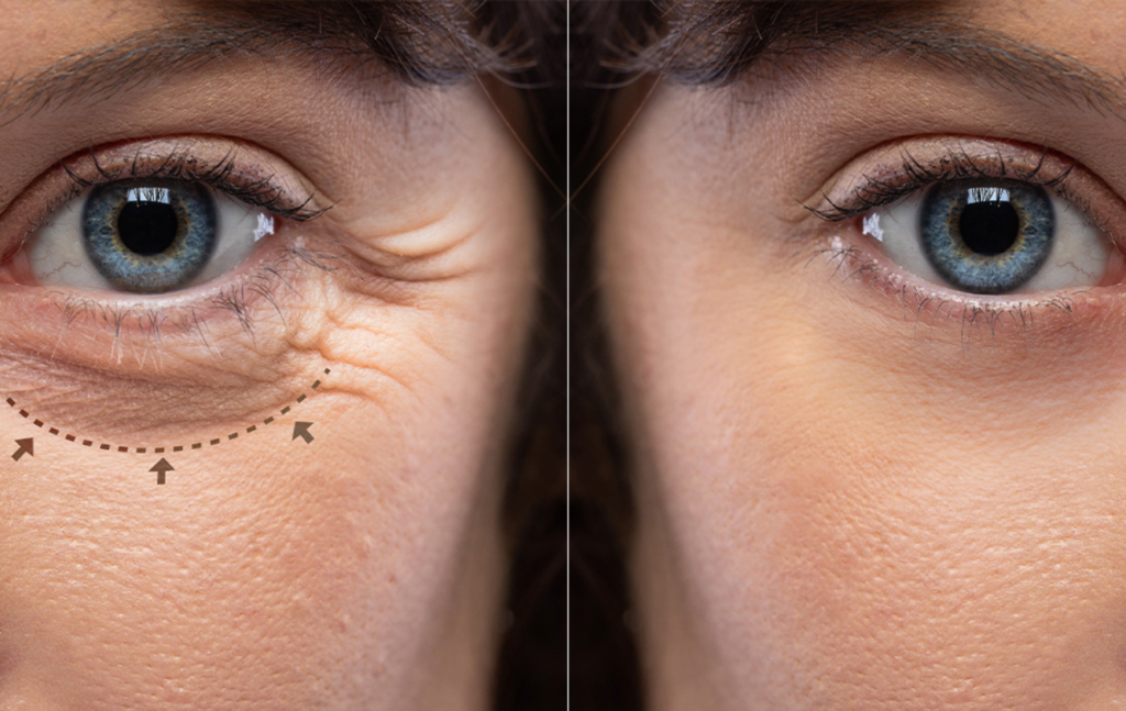 Oculoplasty Treatment in Lucknow